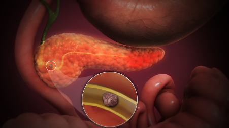 Acute Pancreatitis in India: Alcohol vs Lifestyle Factors