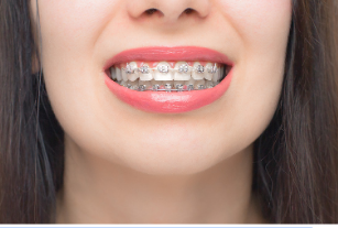 How The Bracket Design Creates a Difference During Treatment 
